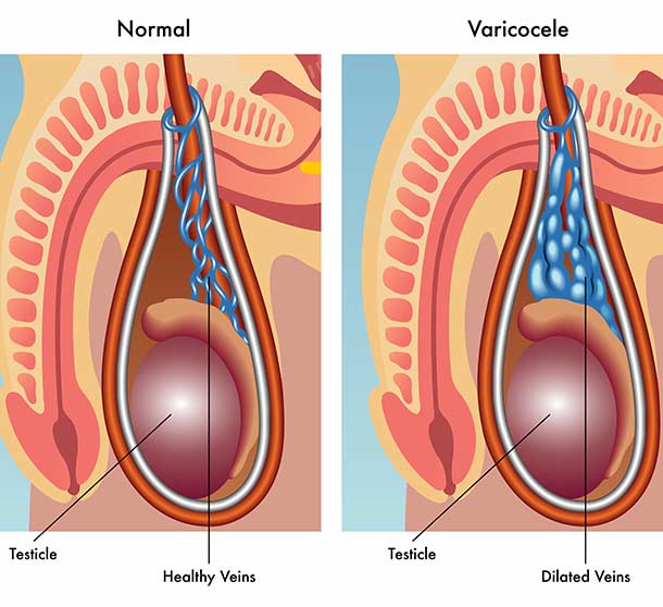 How varicocele leads to infertility in men