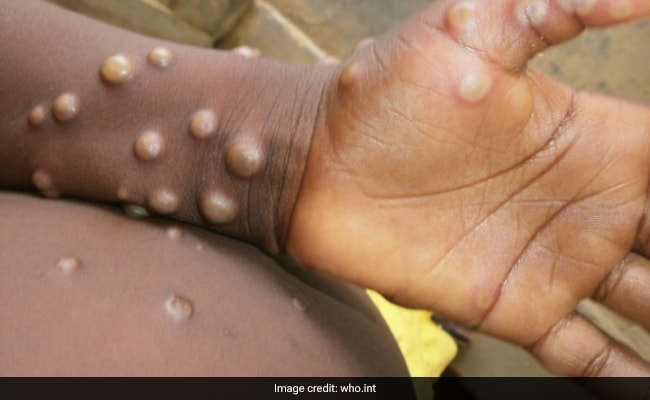 What you don’t know about monkeypox