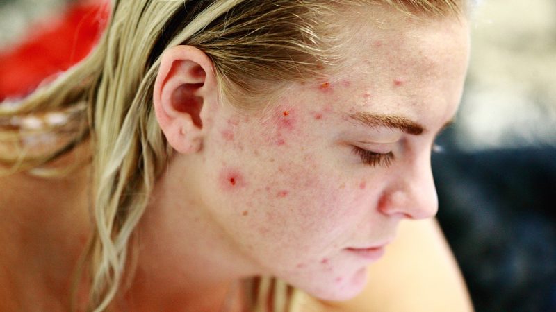 6 effective natural tips to get rid of acne