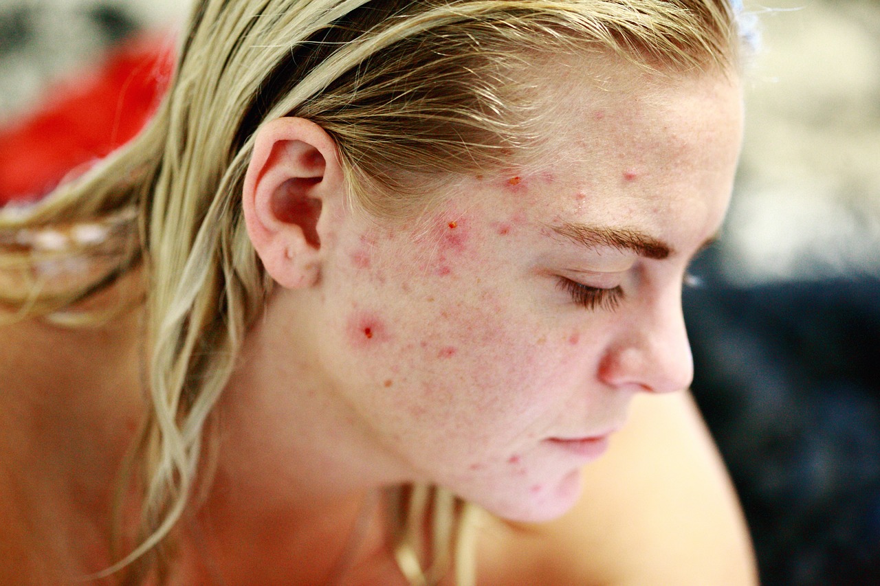 6 effective natural tips to get rid of acne